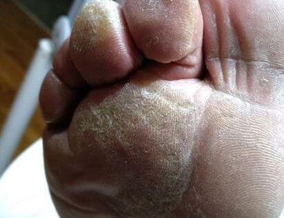 Don't be callus! Pick up that hard skin remover to make your feet